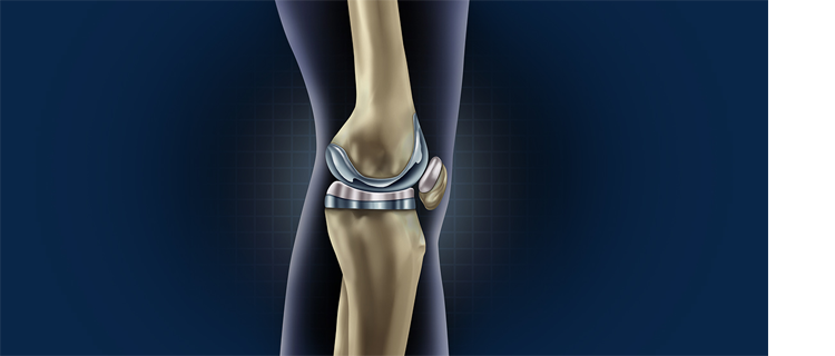 roboticknee