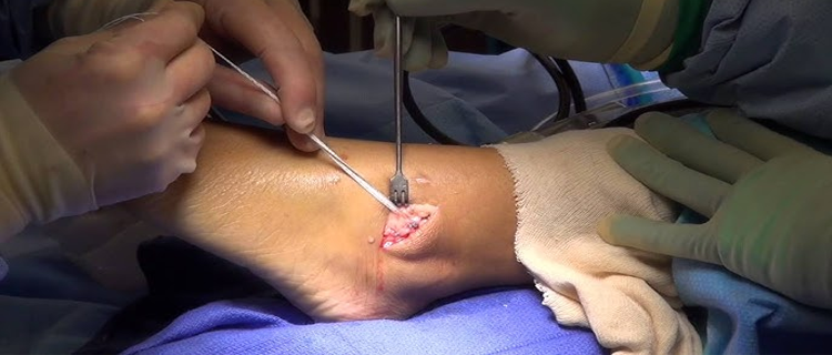 roboticknee