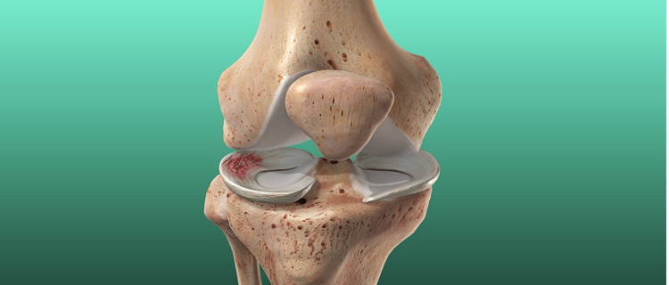 roboticknee